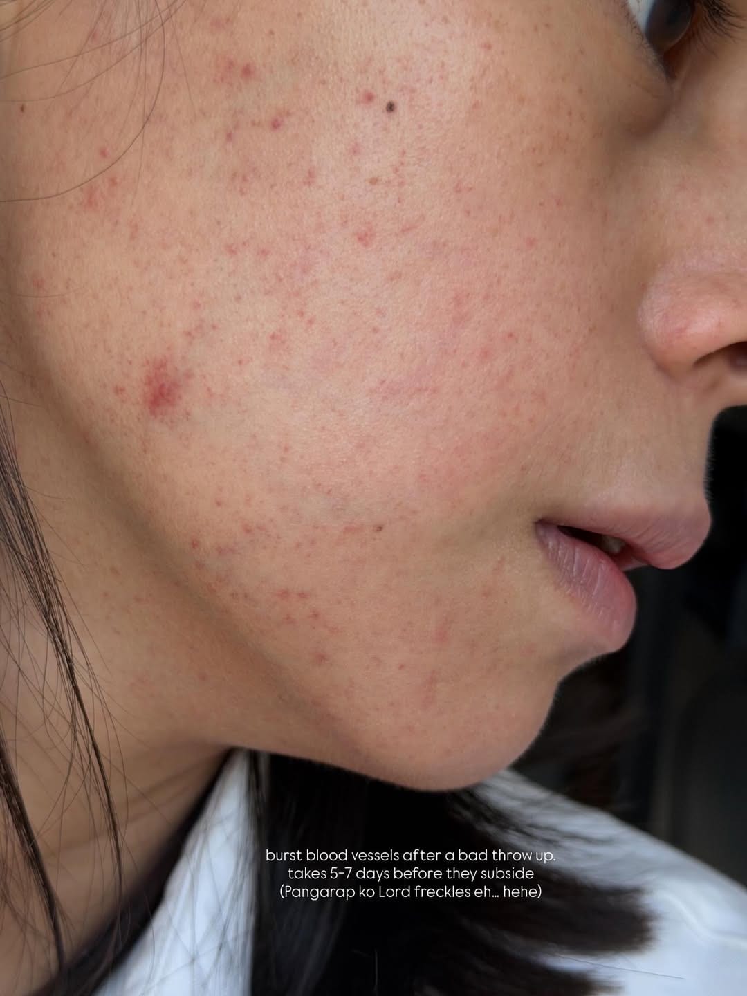 Bettinna Carlos burst blood vessels